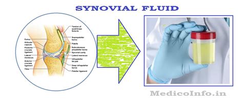 synovial fluid collection and analysis significance collection patient preparation
