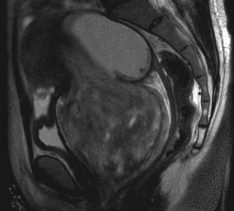 Diffusion Weighted Mr Imaging Of Female Pelvic Tumors A Pictorial