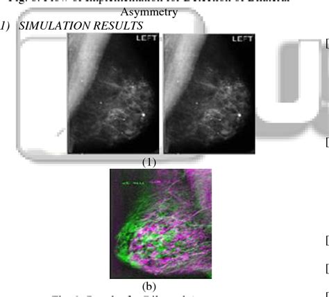 figure 9 from feature extraction from mammograms of breast cancer using automatic thresholding
