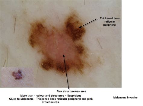 Dermoscopy Made Simple Clues To Melanoma
