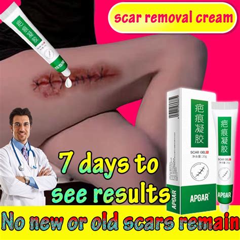Remove Stretch Marks Cream 150ml Preventobesity Lines Old Scar Remover For Legs Peklat Remover