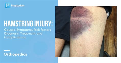 Hamstring Injury Causes Symptoms Risk Factors Diagnosis Treatment