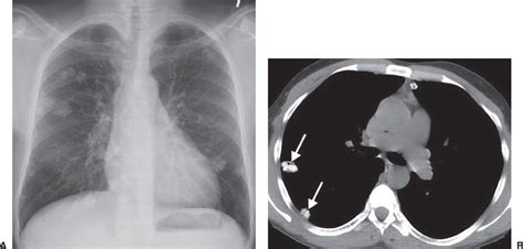 Pulmonary Nodules Radiology