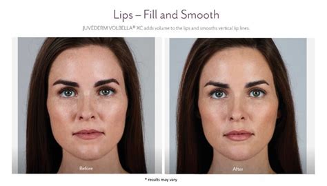 The pen's pressure is adequate to push the filler or alternatively a vitamin cocktail inside the skin. Juvederm Before and After Pictures | Juvederm Westport CT