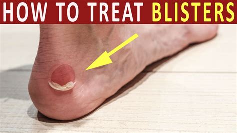 How To Get Rid Of A Foot Blister Numberimprovement23