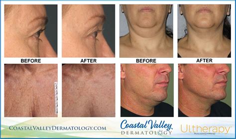 Ultherapy Skin Tightening Coastal Valley Dermatology