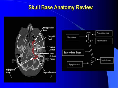 Skull Base Review And Pathology Cranial Anatomy Pathology Anatomy