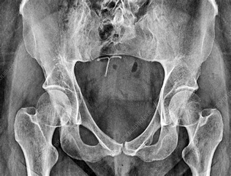 Underdeveloped Pelvic Bones X Ray Stock Image C0299993 Science
