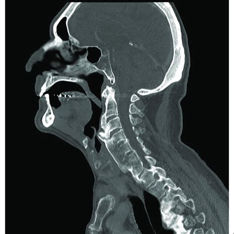 Ct Sagittal Scan Showing Anterior Osteophytes And Ossification Of