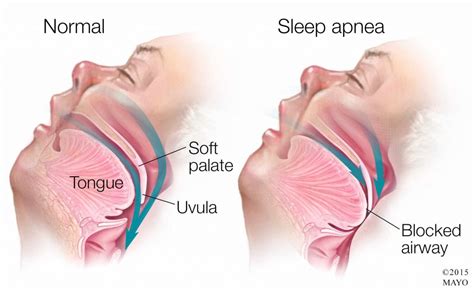 what is obstructive sleep apnea