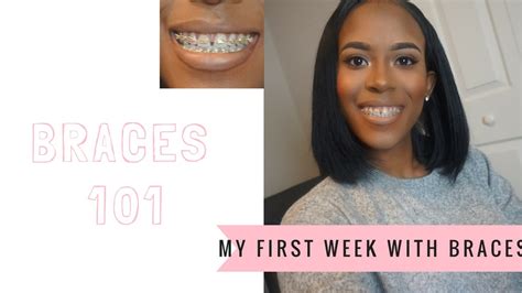 Braces 101 My Experience Getting Braces Youtube