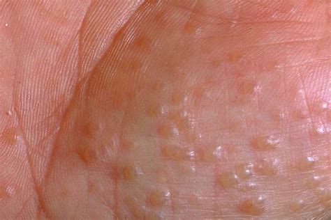 Dyshidrotic Eczema Symptoms Causes Treatment And More Pure Medical