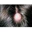 Sebaceous Cyst On Mans Scalp Photograph By Dr P Marazzi/science Photo 