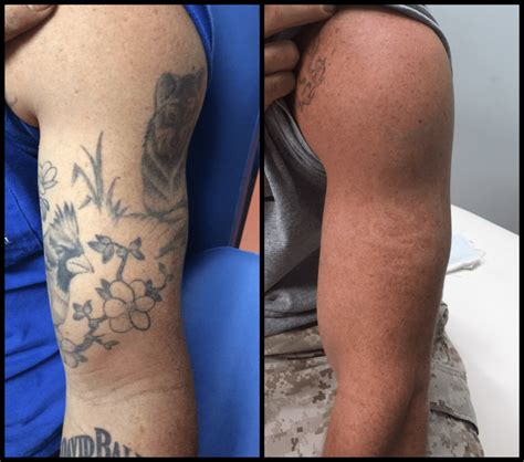 In addition, a worthy note to keep in mind; Laser Tattoo Removal Scars Pictures - Best Tattoo Ideas