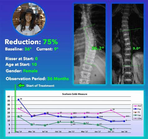 Scoliosis Treatment Cure Without Scoliosis Surgery 75 Red Flickr