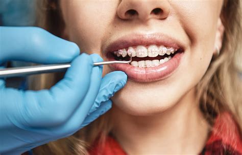 What Is The Process Of Getting Braces Put On Tisseront