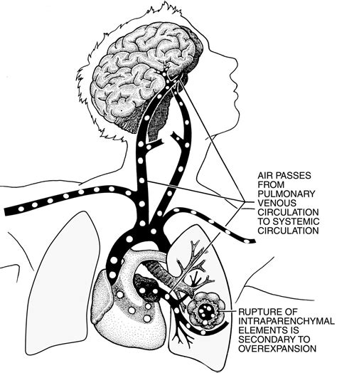 Arterial Gas Embolism And Decompression Sickness Physiology