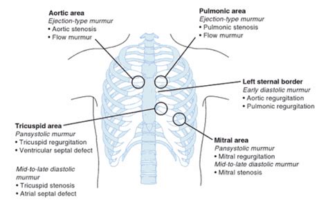 Afbeeldingsresultaat Voor Diastolic Systolic Murmur Cardiac Nursing