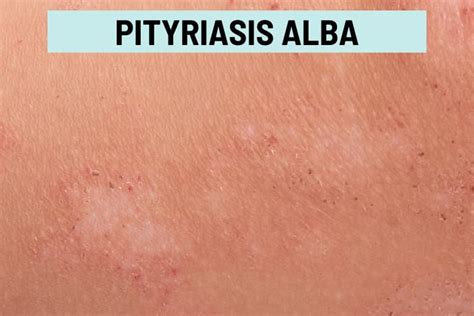 White Spots On Skin 24 Causes Pictures Treatment