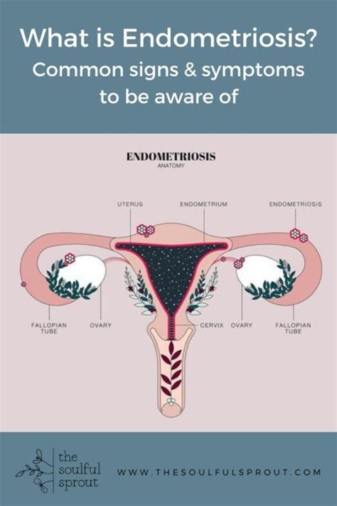 Endometriosis Surgery Immersioninfo Hot Sex Picture