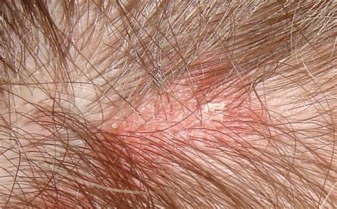 Red Spots On Head Scalp