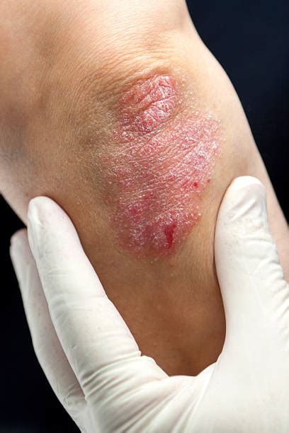 Plaque Psoriasis Stock Photos Pictures And Royalty Free Images Istock