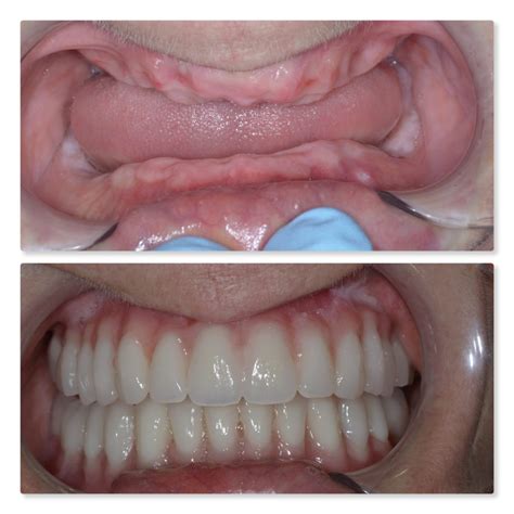 Dental Implant Retained Denture Leeds Securing Your Teeth