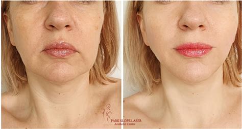 Non Surgical Liquid Facelift With Dermal Fillers Brooklyn Ny Park Slope Brooklyn Ny Park