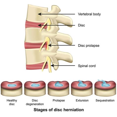 Whats The Difference Between A Herniated Disc And A Bulging Disc