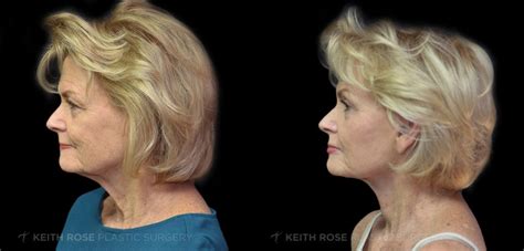 Blepharoplasty Before And After Photos J Keith Rose Md