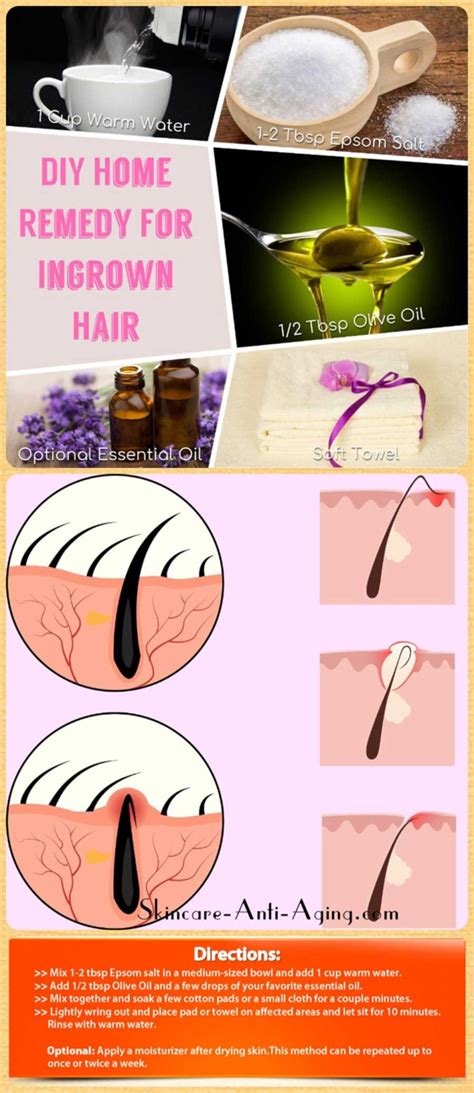 Home Remedies For Ingrown Hair Treatment Fast And Easy Solutions To