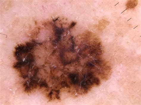 Melanoma Skin Cancer Thegreeks
