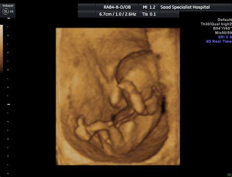 4d Fetal Ultrasound Radrounds Radiology Network