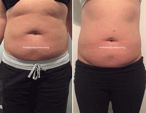 Fat Reduction Treatments Sydney Elite Body Contouring