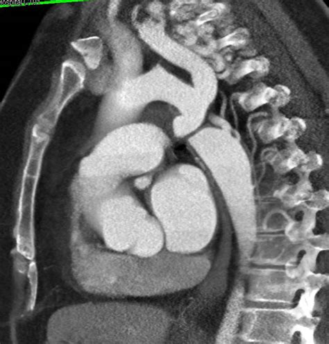 Coarctation Of The Aorta With Intercostal Collaterals And Dilated