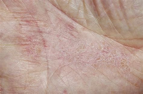 Dermatitis On The Hand Stock Image C0051839 Science Photo Library