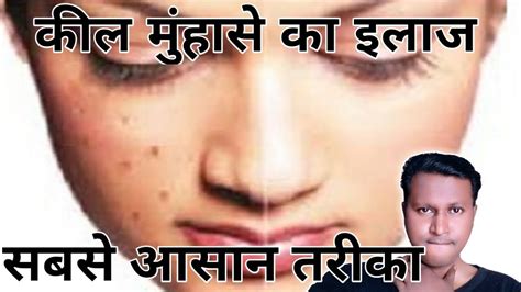 Kil Muhase Hatane Ke Gharelu Upay How To Remove Face Acne And Pimples