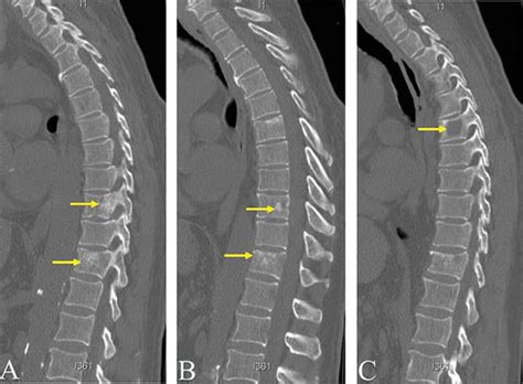 Cholangiocarcinoma Metastasis To The Spine And Cranium Ochsner Journal