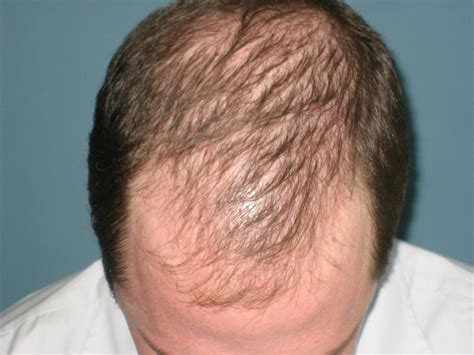 Primary Health Station Various Types Of Hair Loss
