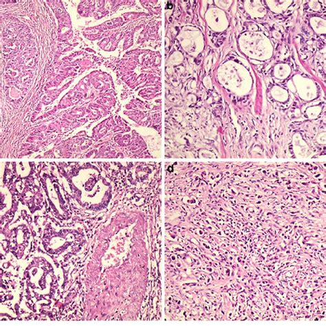 Histological Classiwcation Of Gastric Carcinomas A Diverentiated Type