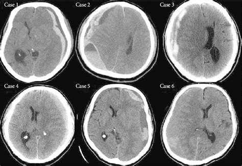 Preoperative CT Scans Of The Acute On Chronic Subdural Hematoma Case 1