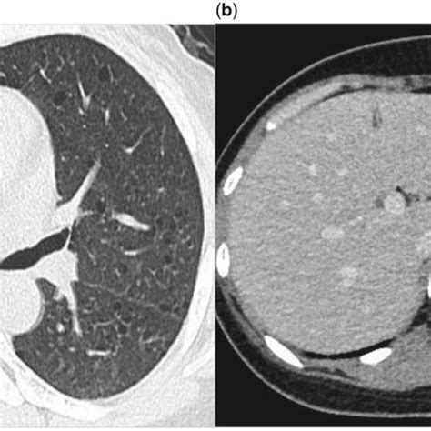 A Chest Ct Scans Showing Multiple Thin Walled Round Well Defined
