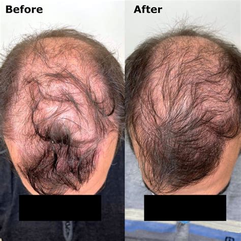 Hair Loss Treatment For Men Precision Aesthetics Medical Group