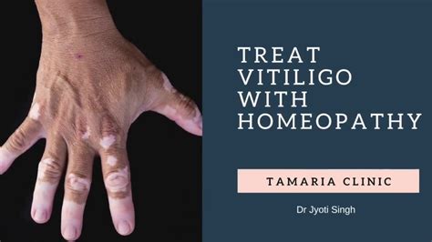 Vitiligo Skin Depigmentation Pathophysiology Signs And Symptoms