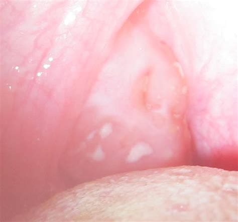 How Common Are Tonsillolith White Tonsils Cancer Lumps League Tonsil