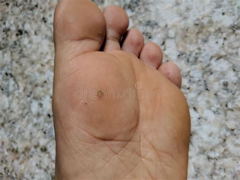 Foot Plantar Warts Skin Disease Dermatology Stock Image Image Of