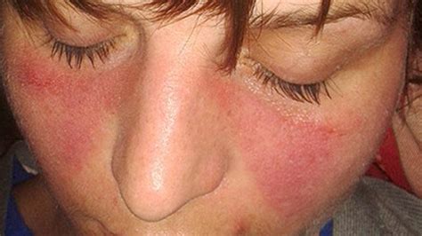 Systemic Lupus Erythematosussle Simptom Punca Dan Cara Rawatan