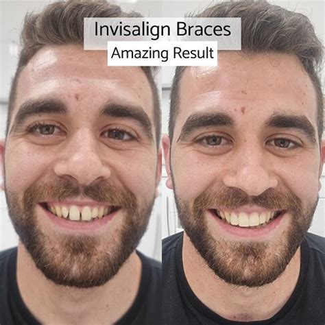 Invisalign Treatment Options London Waterloo Marble Arch Whites Dental