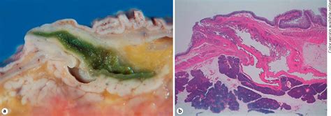 Figure 1 From Major Duodenal Papilla And Its Normal Anatomy Semantic