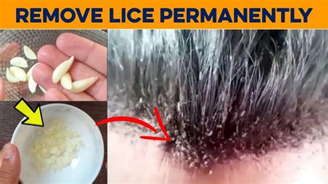 Search for does hair dye get rid head lice. How to Get Rid of Lice Permanently in 1 Hour - Remove Lice ...